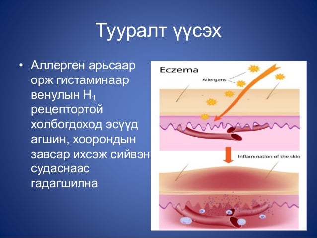 атопийн дерматит