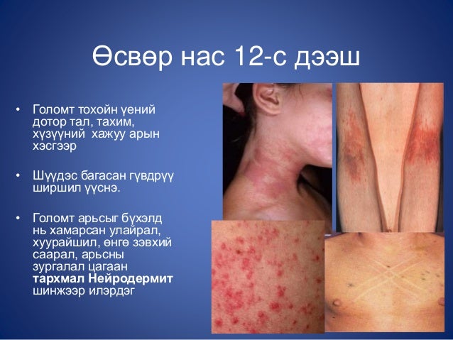 атопийн дерматит