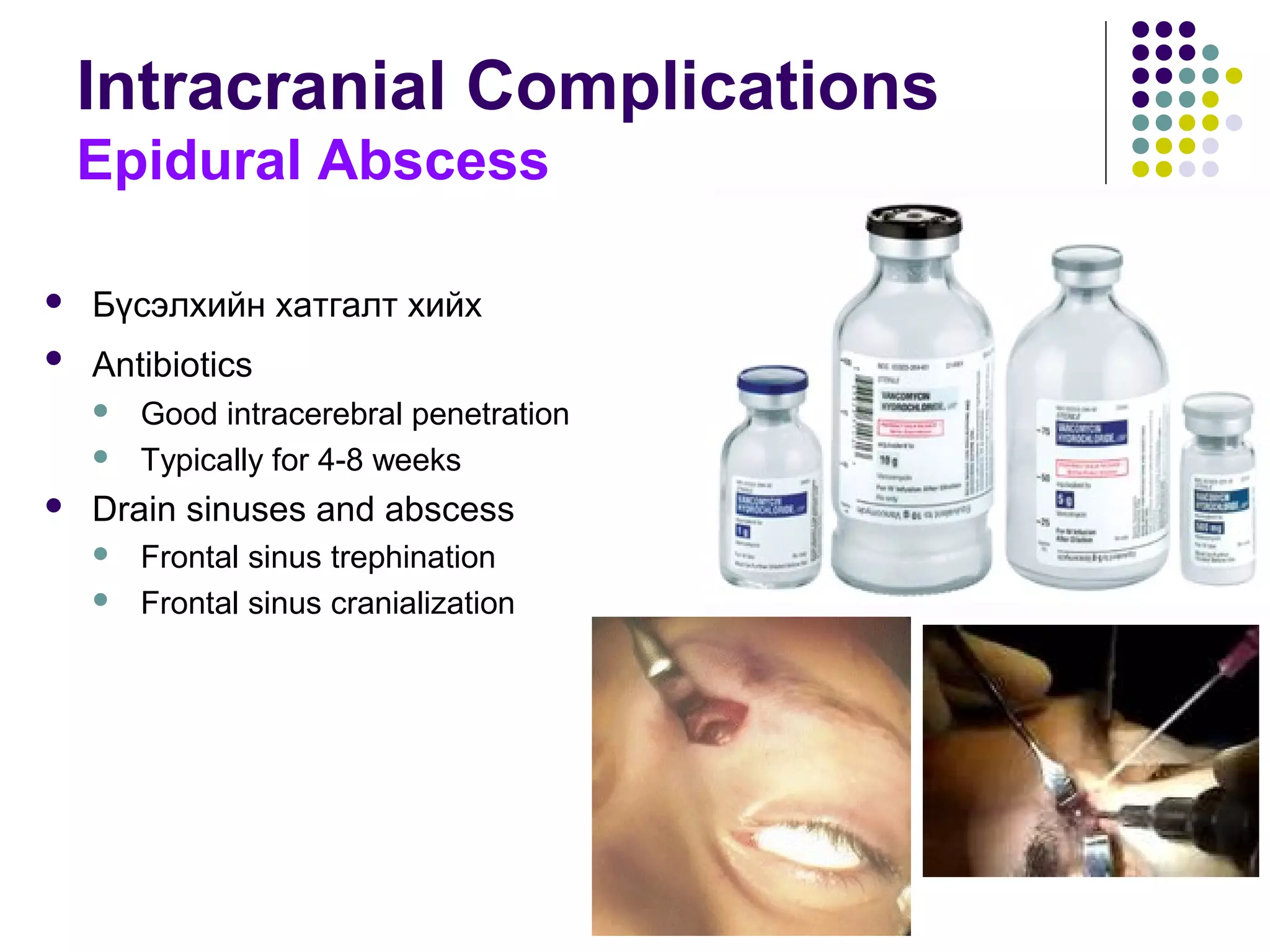 Intracranial Complications
Epidural Abscess
 Бүсэлхийн хатгалт хийх
 Antibiotics
 Good intracerebral penetration
 Typically for 4-8 weeks
 Drain sinuses and abscess
 Frontal sinus trephination
 Frontal sinus cranialization
 
