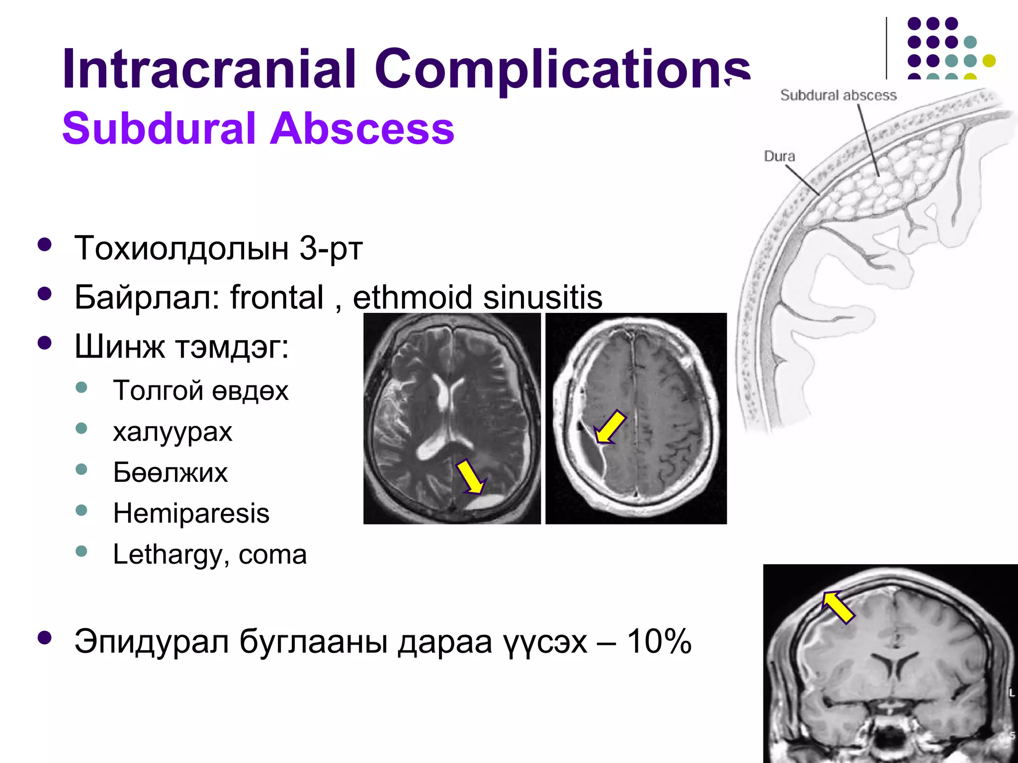 Intracranial Complications
Subdural Abscess
 Тохиолдолын 3-рт
 Байрлал: frontal , ethmoid sinusitis
 Шинж тэмдэг:
 Толгой өвдөх
 халуурах
 Бөөлжих
 Hemiparesis
 Lethargy, coma
 Эпидурал буглааны дараа үүсэх – 10%
 