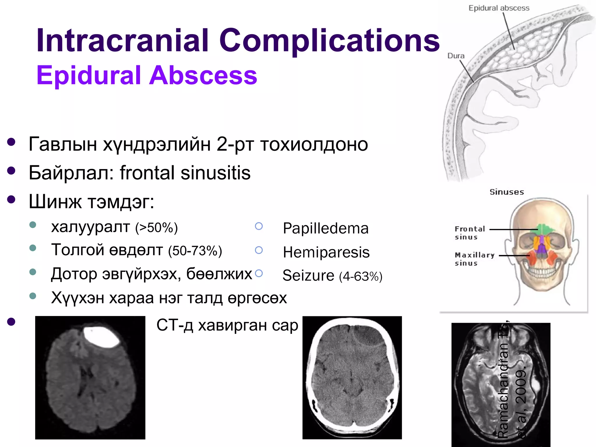 Intracranial Complications
Epidural Abscess
RamachandranTS,
etal,2009.
 Papilledema
 Hemiparesis
 Seizure (4-63%)
 Гавлын хүндрэлийн 2-рт тохиолдоно
 Байрлал: frontal sinusitis
 Шинж тэмдэг:
 халууралт (>50%)
 Толгой өвдөлт (50-73%)
 Дотор эвгүйрхэх, бөөлжих
 Хүүхэн хараа нэг талд өргөсөх
 CT-д хавирган сар
 