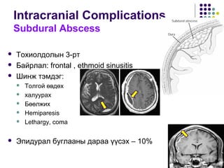 Intracranial Complications
Subdural Abscess
 Тохиолдолын 3-рт
 Байрлал: frontal , ethmoid sinusitis
 Шинж тэмдэг:
 Толгой өвдөх
 халуурах
 Бөөлжих
 Hemiparesis
 Lethargy, coma
 Эпидурал буглааны дараа үүсэх – 10%
 