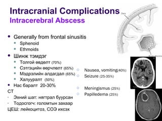 Intracranial Complications
Intracerebral Abscess
 Generally from frontal sinusitis
 Sphenoid
 Ethmoids
 Шинж тэмдэг
 Толгой өвдөлт (70%)
 Сэтгэцийн өөрчлөлт (65%)
 Мэдрэлийн алдагдал (65%)
 Халууралт (50%)
 Нас баралт 20-30%
СТ
- Эхний шат: нягтрал буурсан
- Тодосгогч: голомтын захаар
ЦЕШ: лейкоцитоз, СОЭ ихсэх
 Nausea, vomiting(40%)
 Seizure (25-35%)
 Meningismus (25%)
 Papilledema (25%)
 