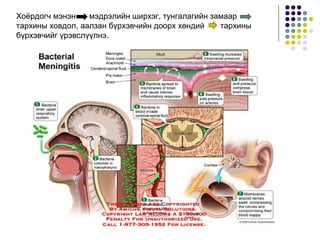 Хоёрдогч мэнэн мэдрэлийн ширхэг, тунгалагийн замаар
тархины ховдол, аалзан бүрхэвчийн доорх хөндий тархины
бүрхэвчийг үрэвслүүлнэ.
 