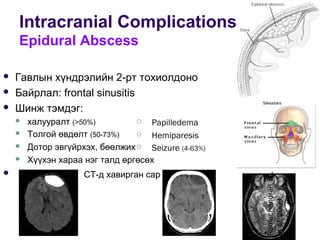 Intracranial Complications
Epidural Abscess
RamachandranTS,
etal,2009.
 Papilledema
 Hemiparesis
 Seizure (4-63%)
 Гавлын хүндрэлийн 2-рт тохиолдоно
 Байрлал: frontal sinusitis
 Шинж тэмдэг:
 халууралт (>50%)
 Толгой өвдөлт (50-73%)
 Дотор эвгүйрхэх, бөөлжих
 Хүүхэн хараа нэг талд өргөсөх
 CT-д хавирган сар
 