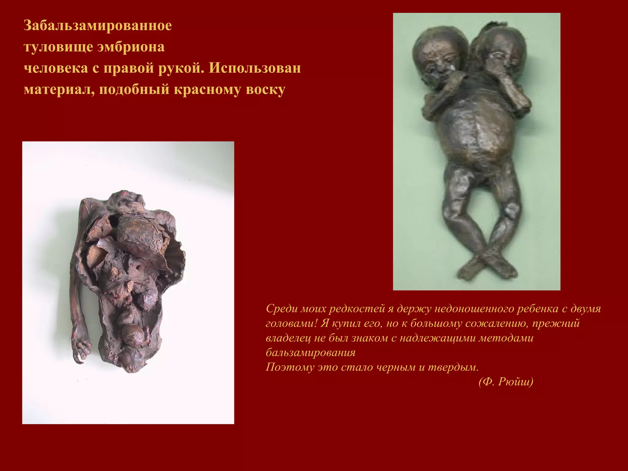 Забальзамированное
туловище эмбриона
человека с правой рукой. Использован
материал, подобный красному воску
Среди моих редкостей я держу недоношенного ребенка с двумя
головами! Я купил его, но к большому сожалению, прежний
владелец не был знаком с надлежащими методами
бальзамирования
Поэтому это стало черным и твердым.
(Ф. Рюйш)
 