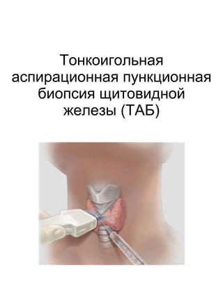 Тонкоигольная
аспирационная пункционная
биопсия щитовидной
железы (ТАБ)
 
