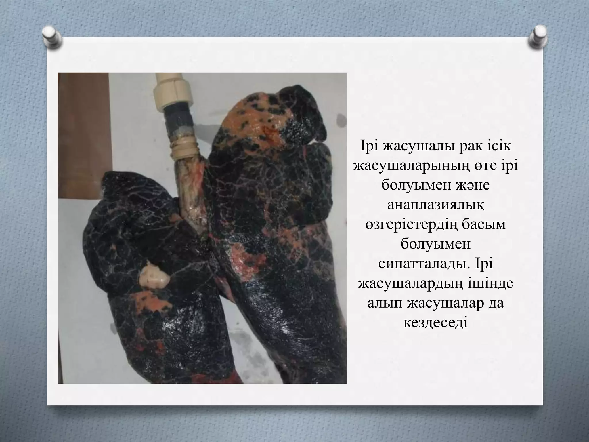 Ірі жасушалы рак ісік
жасушаларының өте ірі
болуымен және
анаплазиялық
өзгерістердің басым
болуымен
сипатталады. Ірі
жасушалардың ішінде
алып жасушалар да
кездеседі
 