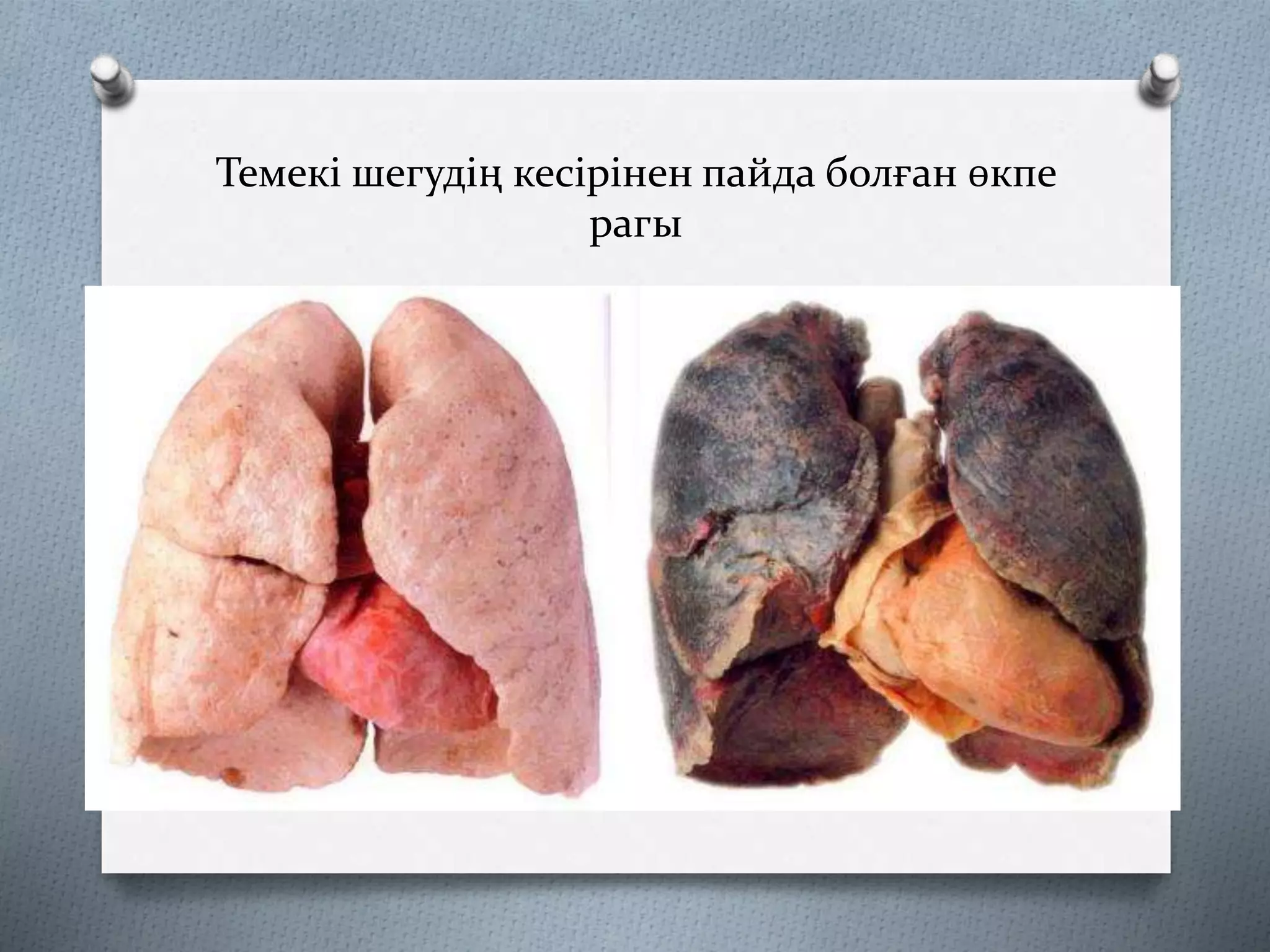 Темекі шегудің кесірінен пайда болған өкпе
рагы
 