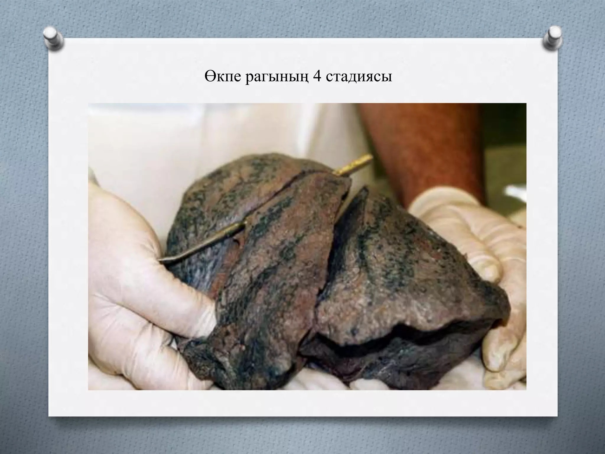 Өкпе рагының 4 стадиясы
 