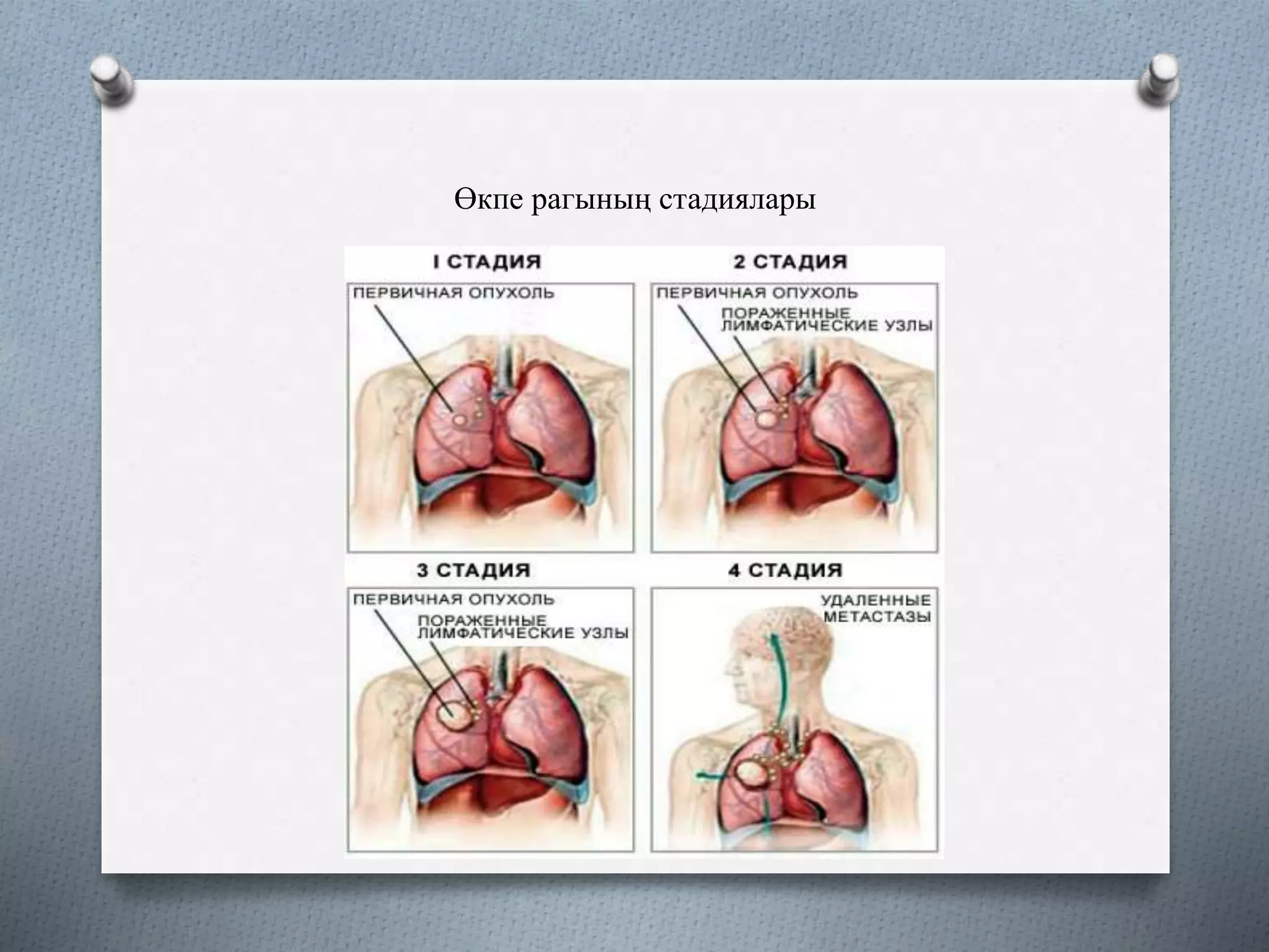 Өкпе рагының стадиялары
 