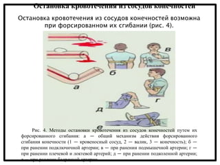 Остановка кровотечения из сосудов конечностей
Остановка кровотечения из сосудов конечностей возможна
при форсированном их сгибании (рис. 4).
Рис. 4. Методы остановки кровотечения из сосудов конечностей путем их
форсированного сгибания: а — общий механизм действия форсированного
сгибания конечности (1 — кровеносный сосуд, 2 — валик, 3 — конечность); б —
при ранении подключичной артерии; в — при ранении подмышечной артерии; г —
при ранении плечевой и локтевой артерий; д — при ранении подколенной артерии;
е — при ранении бедренной артерии.
 
