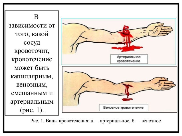 Классификация форестер кровотечения