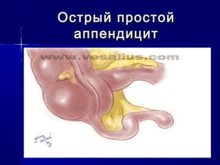 Острый простойОстрый простой
аппендицитаппендицит
 
