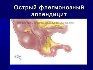Острый флегмонозныйОстрый флегмонозный
аппендицитаппендицит
 