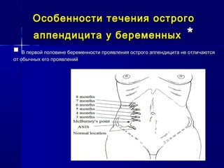 Особенности течения острогоОсобенности течения острого
аппендицита у беременныхаппендицита у беременных **
 В первой половине беременности проявления острого аппендицита не отличаютсяВ первой половине беременности проявления острого аппендицита не отличаются
от обычных его проявленийот обычных его проявлений
 