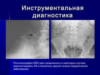 ИнструментальнаяИнструментальная
диагностикадиагностика
Рентгенография ОБП дает возможность в некоторых случаях
диагностировать ОА и исключить другие острые хирургическое
заболевания.
 