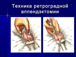 Техника ретрограднойТехника ретроградной
аппендэктомииаппендэктомии
 