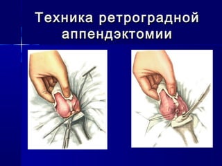 Техника ретрограднойТехника ретроградной
аппендэктомииаппендэктомии
 