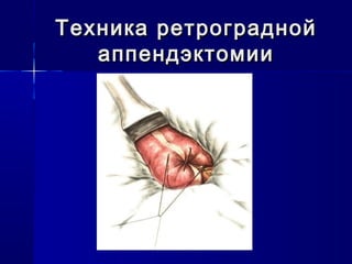 Техника ретрограднойТехника ретроградной
аппендэктомииаппендэктомии
 