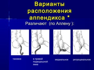 ВариантыВарианты
расположениярасположения
аппендиксааппендикса **
Различают (по Аллену ):Различают (по Аллену ):
тазовое в правой
подвздошной
ямке
медиальное ретроцекальное
 