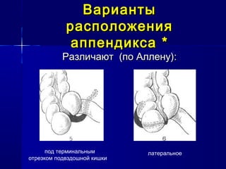 ВариантыВарианты
расположениярасположения
аппендиксааппендикса **
Различают (по Аллену):Различают (по Аллену):
под терминальным
отрезком подвздошной кишки
латеральное
 