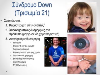 Σύνδρομο Down
(Τρισωμία 21)
• Συμπτώματα:
1. Καθυστέρηση στην ανάπτυξη
2. Χαρακτηριστικές δυσμορφίες στο
πρόσωπο (μογγολοειδή χαρακτηριστικά)
3. Διανοητική καθυστέρηση
• Υποτονία
• Φαρδύς & κοντός κορμός
• Δυσπλαστικά αφτιά
• Χαρακτηριστικές γραμμές χεριών
• Δυσπλαστικός φάρυγγας
• Επικάνθιες αναδιπλώσεις
• Οξεία λευχαιμία
• 1/1000 γεννήσεις
 
