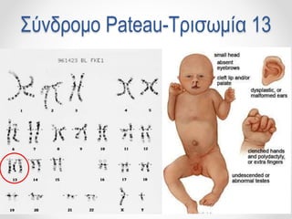 Σύνδρομο Pateau-Τρισωμία 13
 