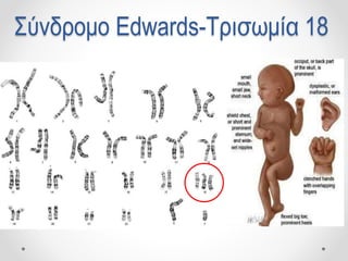 Σύνδρομο Edwards-Τρισωμία 18
 