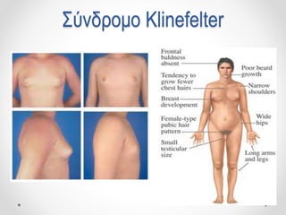 Σύνδρομο Klinefelter
 