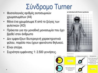 Σύνδρομο Turner
• Φυσιολογικός αριθμός αυτοσωμικών
χρωμοσωμάτων (44)
• Μόνο ένα χρωμόσωμα Χ από το ζεύγος των
φυλετικών (ΧΟ)
• Πρόκειται για την μοναδική μονοσωμία που έχει
βρεθεί στον άνθρωπο
• Δεν εμφανίζουν δευτερογενή χαρακτηριστικά
φύλου, παρόλο που έχουν φαινότυπο θηλυκού.
• Είναι στείρα.
• Συχνότητα εμφάνισης 1: 2.500 γεννήσεις.
 