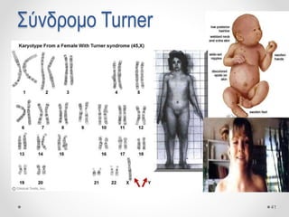 41
Σύνδρομο Turner
 