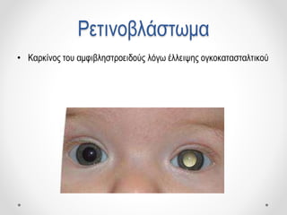 Ρετινοβλάστωμα
• Καρκίνος του αμφιβληστροειδούς λόγω έλλειψης ογκοκατασταλτικού
 