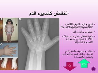 ‫الكاذب‬ ‫الدرق‬ ‫جارات‬ ‫قصور‬
Pseudohypoparathyroidism
‫نادر‬ ‫وراثي‬ ‫اضطراب‬
‫مستقبالت‬ ‫عمل‬ ‫تعطل‬ ‫طفرة‬
PTH‫استجابة‬ ‫تتناقص‬
‫لتأثيراته‬ ‫االنسجة‬
‫عامة‬ ‫جسدية‬ ‫صفات‬(‫قصر‬
‫القامة‬,‫بدانة‬,‫اليد‬ ‫عظام‬ ‫قصر‬
‫والقدم‬,‫تكلسات‬)
Ca PTH
 