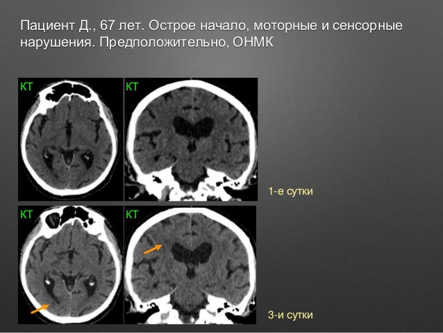 Моторные нарушения это