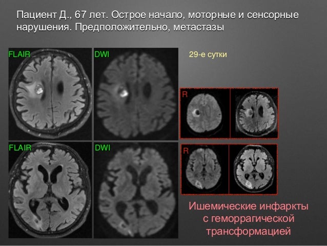 Моторные нарушения патофизиология