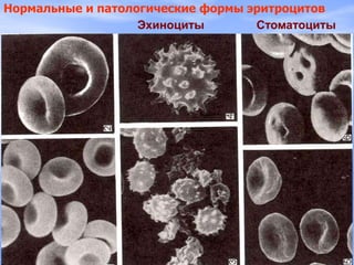 Нормальные и патологические формы эритроцитов
Эхиноциты Стоматоциты
 