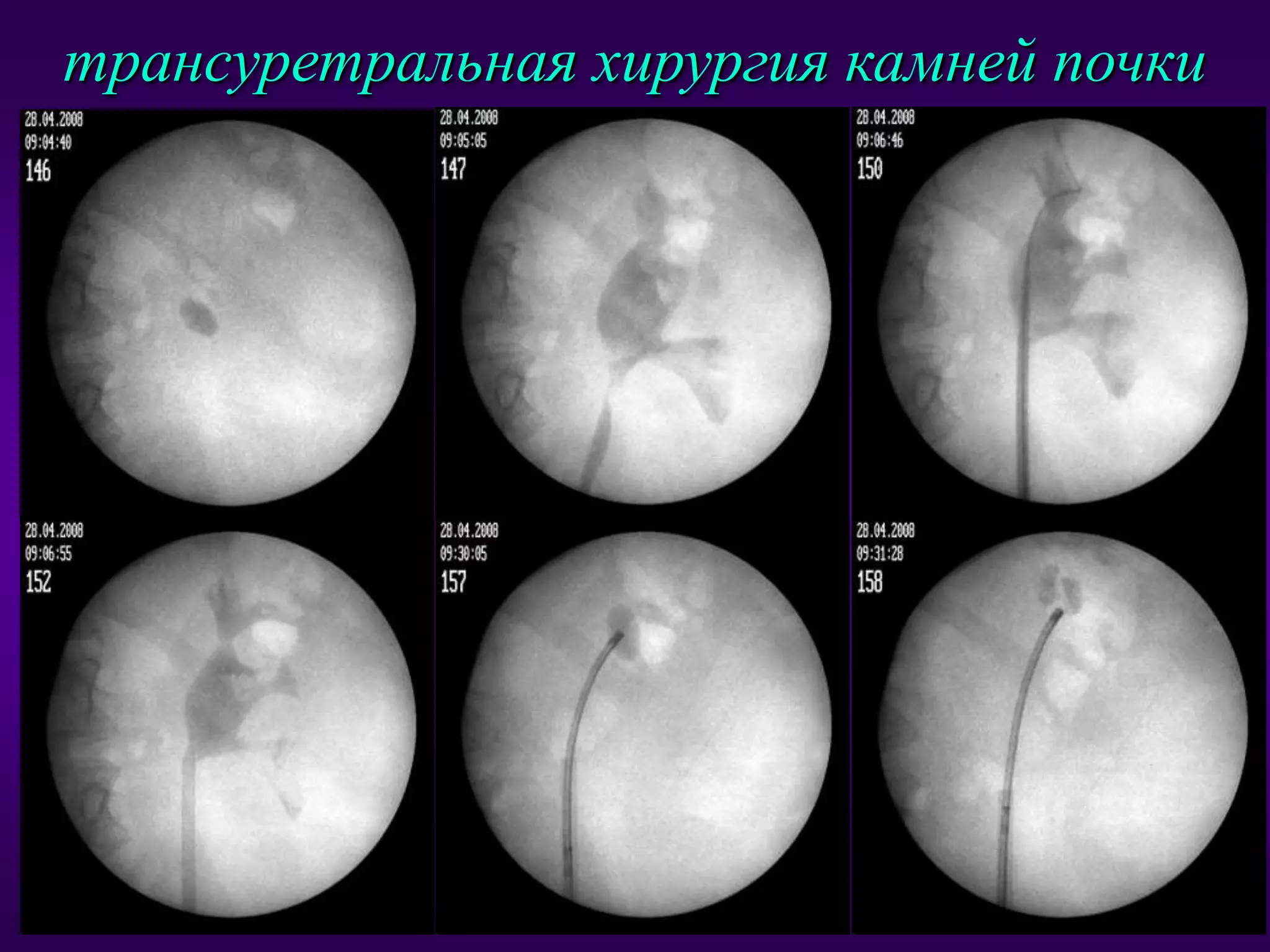 Инновации в лечении мкб | PPT | Free Download