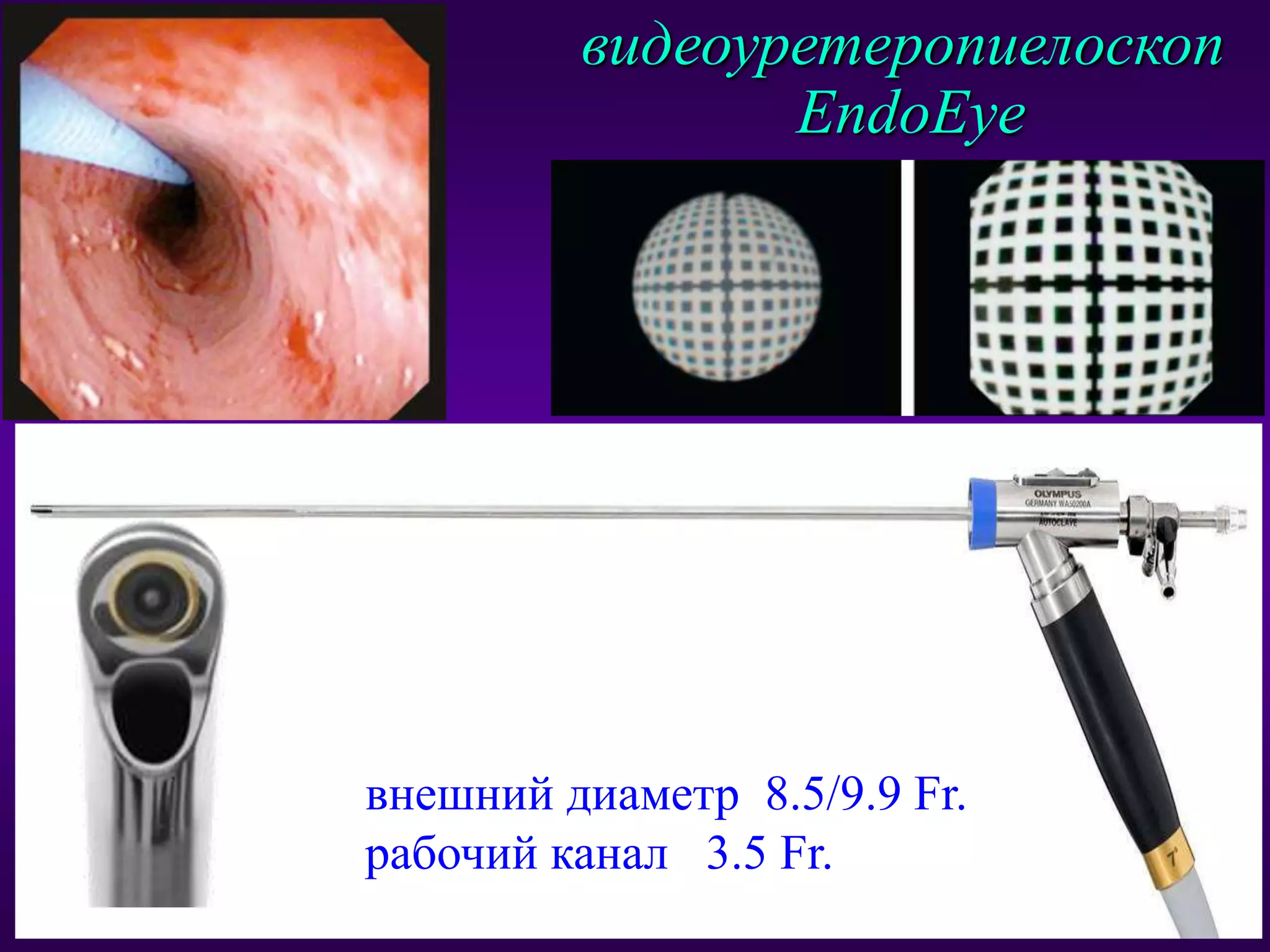 Инновации в лечении мкб | PPT | Free Download