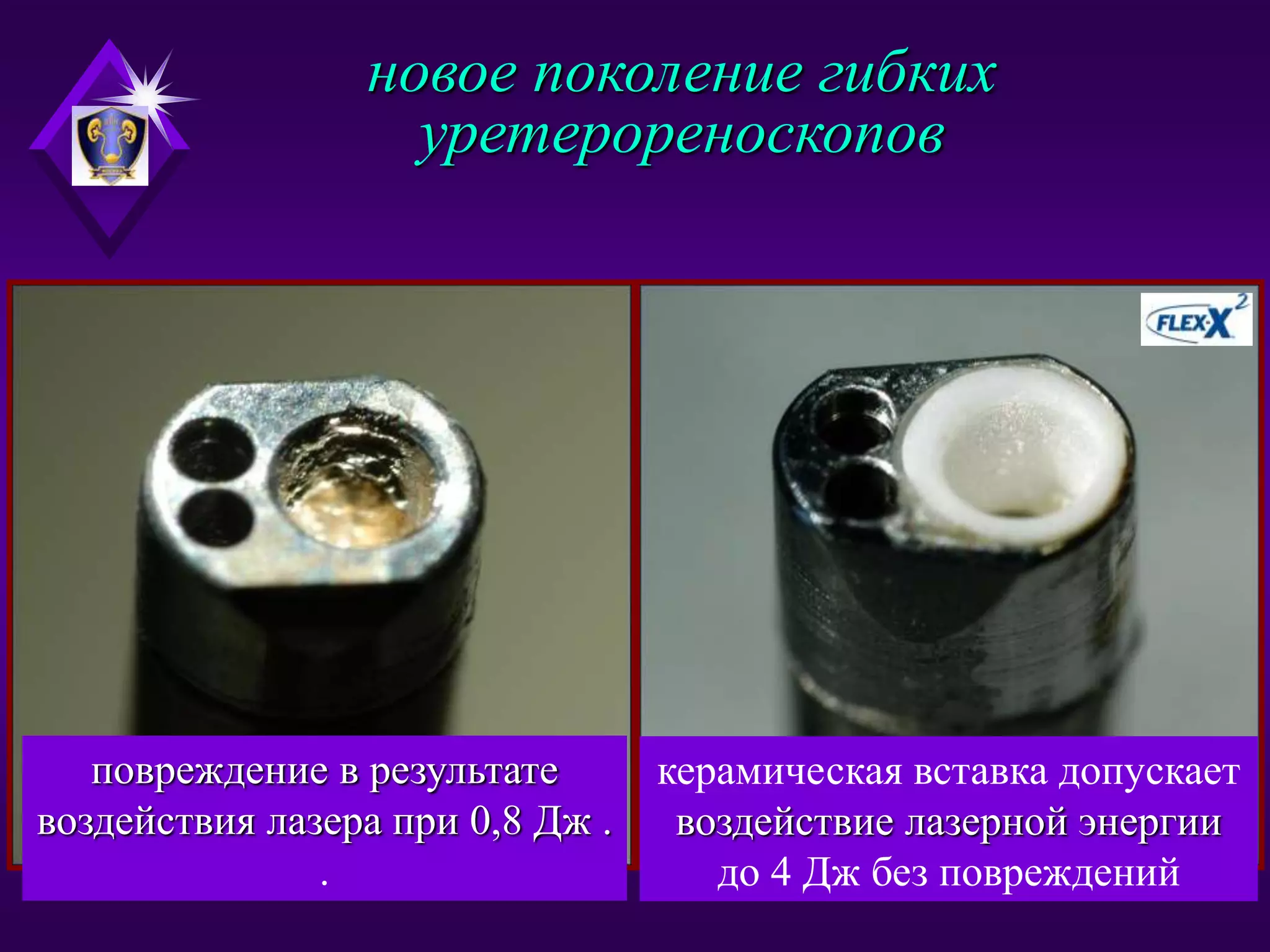 Инновации в лечении мкб | PPT | Free Download