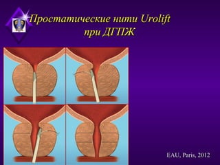 Простатические нити UroliftПростатические нити Urolift
при ДГПЖпри ДГПЖ
EAU, Paris, 2012EAU, Paris, 2012
 