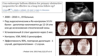 Figure
Journal of Pediatric Urology 2015 11, 37.e1-37.e6DOI: (10.1016/j.jpurol.2014.09.005)
Copyright © 2015 Journal of Pediatric Urology Company
• 2000 – 2010 гг., 19 больных.
• Под эндоскопическим и Ro-контролем 3-5 Fr
балон - дилататор накачивается до 12-14 атм
или до исчезновения стенотической зоны.
• Установленный JJ стент удалялся через 2 мес.
• Контроль: УЗИ, MAG-3 ренография.
• Эффективность 90%, повторная дилатация - 1
случай, уретеролитотомия – 2 случая.
J Pediatr Urol. 2015 Feb;11(1):37.e1-6
 
