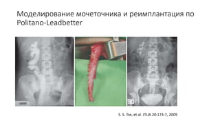 Моделирование мочеточника и реимплантация по
Politano-Leadbetter
S. S. Tse, et al. JTUA 20:173-7, 2009
 