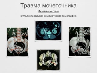 Травма мочеточника
Мультиспиральная компьютерная томография
Лучевые методы
 