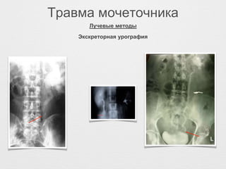 Травма мочеточника
Экскреторная урография
Лучевые методы
 