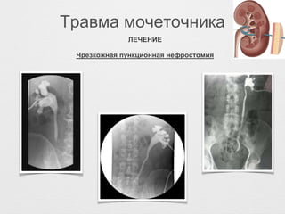 Травма мочеточника
ЛЕЧЕНИЕ
Чрезкожная пункционная нефростомия
 