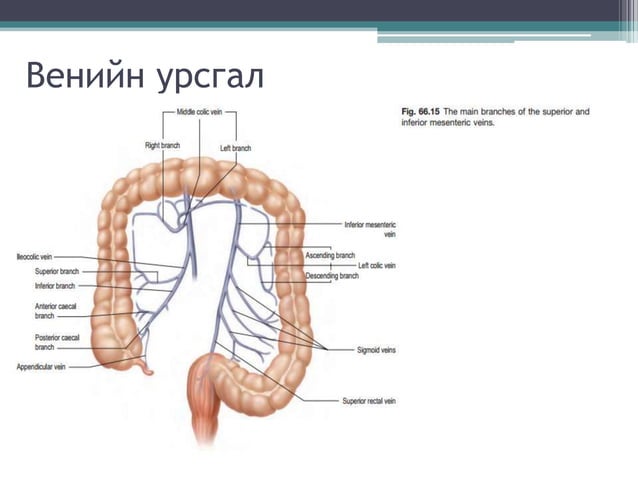Бүдүүн гэдэсний хорт хавдар | PPT