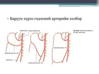 • Баруун хүрээ гэдэсний артерийн хэлбэр
 