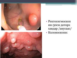 • Ректосигмоскоп
ин-30см доторх
хавдар /анусаас/
• Колоноскопи:
 
