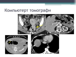 Компьютерт томографи
 